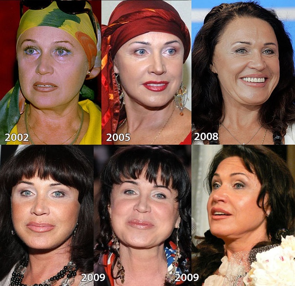 БОТОКС: ИСТОРИЯ УКОЛОВ КРАСОТЫ Несмотря на огромную популярность Уколов красоты, ботокс в косметологии начали использовать чуть более 20-ти лет назад.Ботулотоксин белок, вырабатываемый