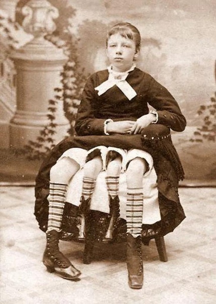 Девушка с удвоенным тазом и четырьмя ногами. Её звали Мертл Корбин и родилась она в 1868 году . Всю жизнь Мертл провела в цирке, но позже вышла замуж за врача, родила пятерых детей, которых она